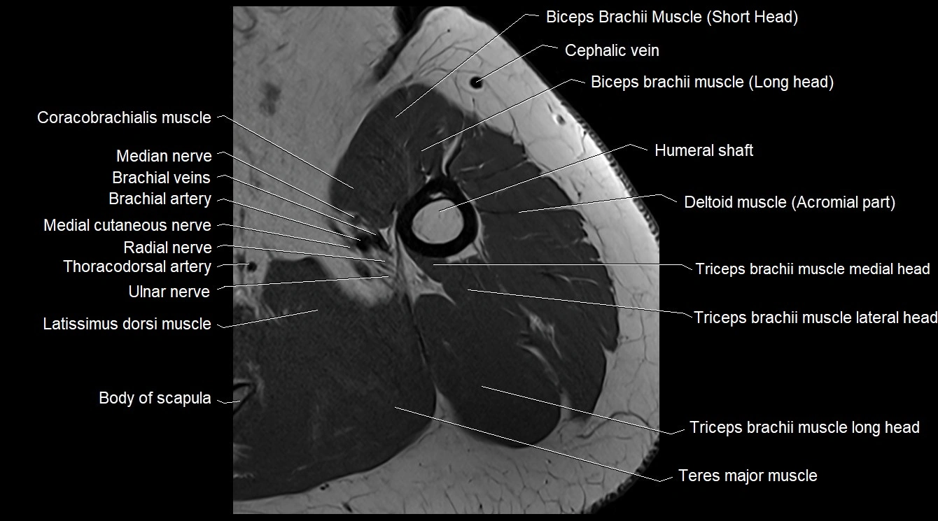 Upper arm( humerus) cross section anatomy MRI 3T axial image 23.webp